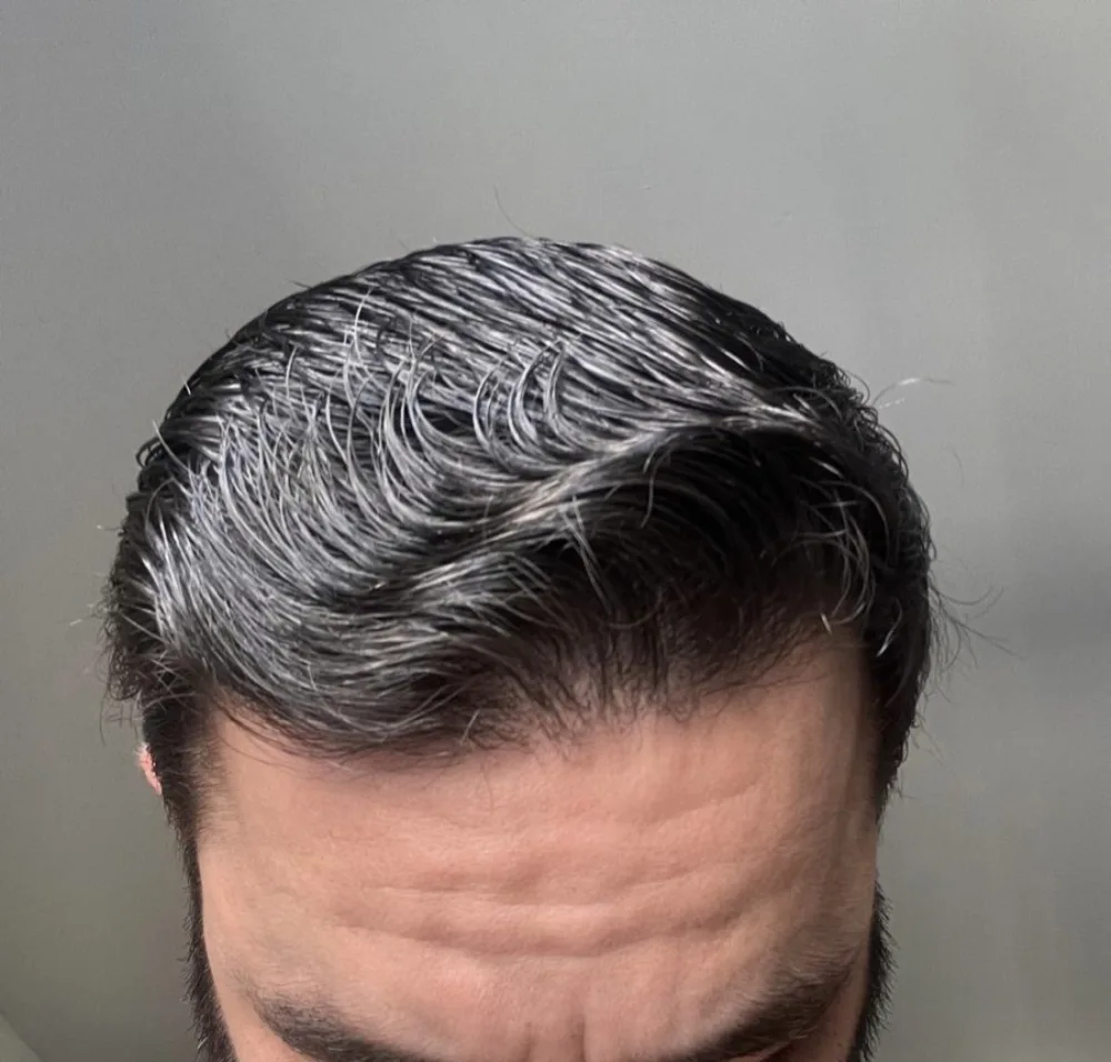 Depois do transplante capilar FUE: linha frontal reconstruída