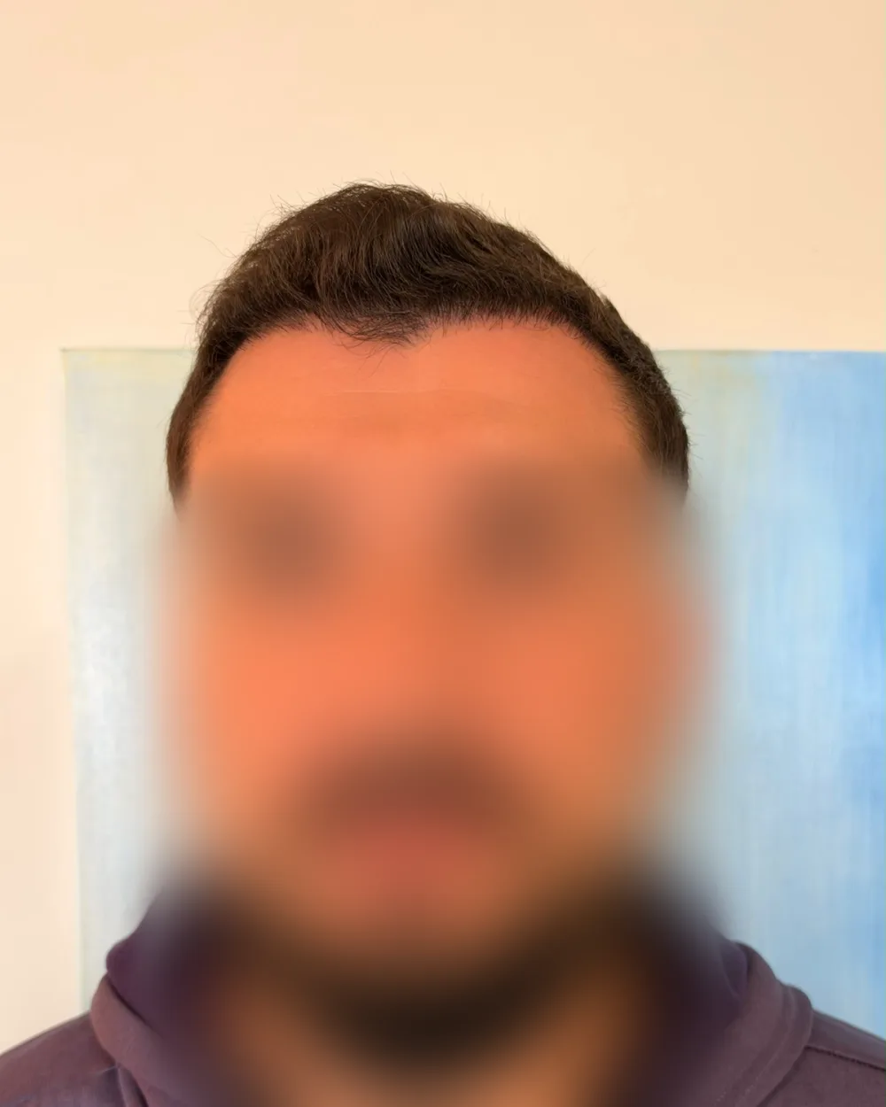 Depois do transplante capilar: linha frontal e entradas reconstruídas